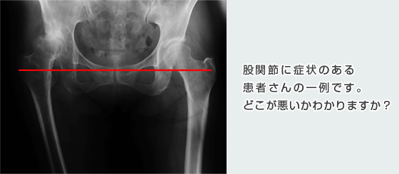 宇都宮記念病院で股関節に症状がある患者様の例