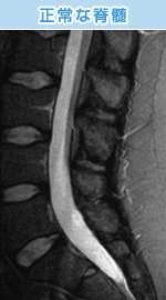 脊柱管狭窄症、坐骨神経痛、椎間板ヘルニアのない正常な脊髄